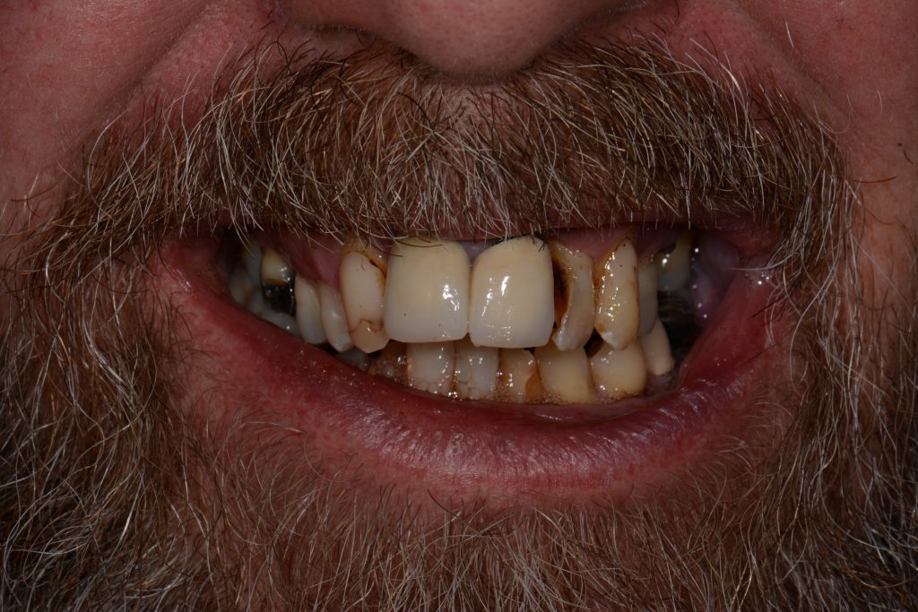 Parkside Dental smile transformation before