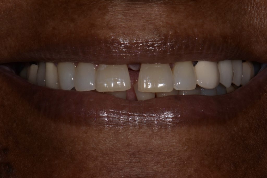 Parkside Dental smile transformation before