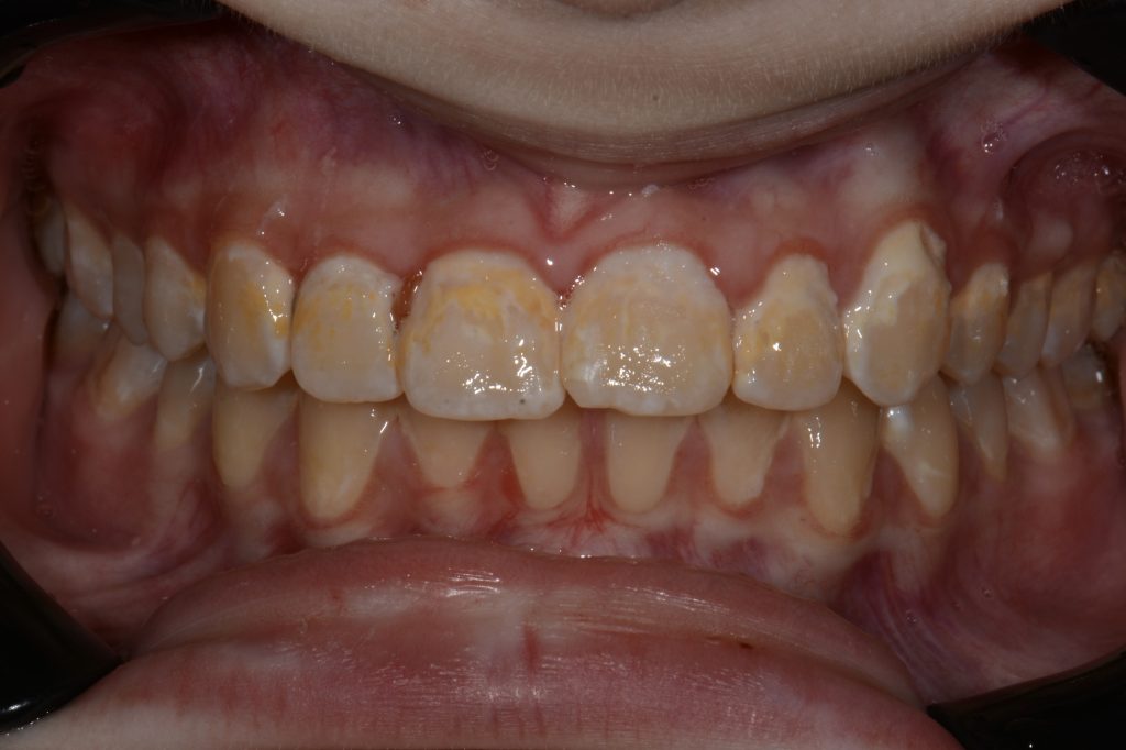 Parkside Dental smile transformation before