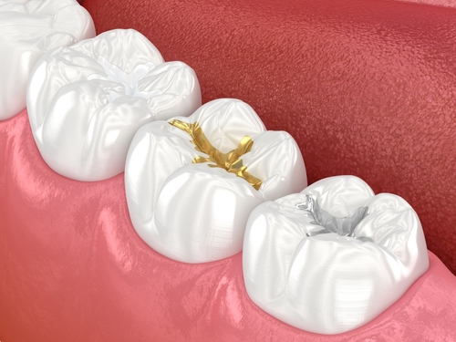 dental fillings at Parkside Dental