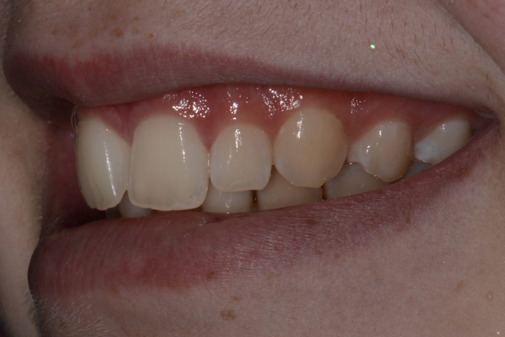 Parkside Dental smile transformation before
